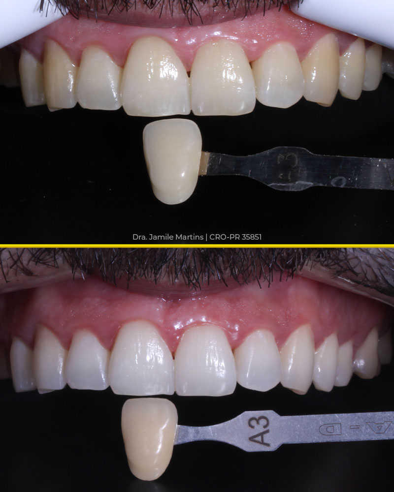 Clareamento dental antes e depois caso 01 — Dra. Jamile Martins