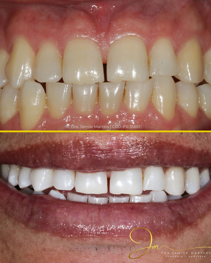 Clareamento dental antes e depois caso 02 — Dra. Jamile Martins