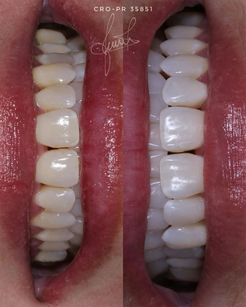 Clareamento dental antes e depois caso 03 — Dra. Jamile Martins