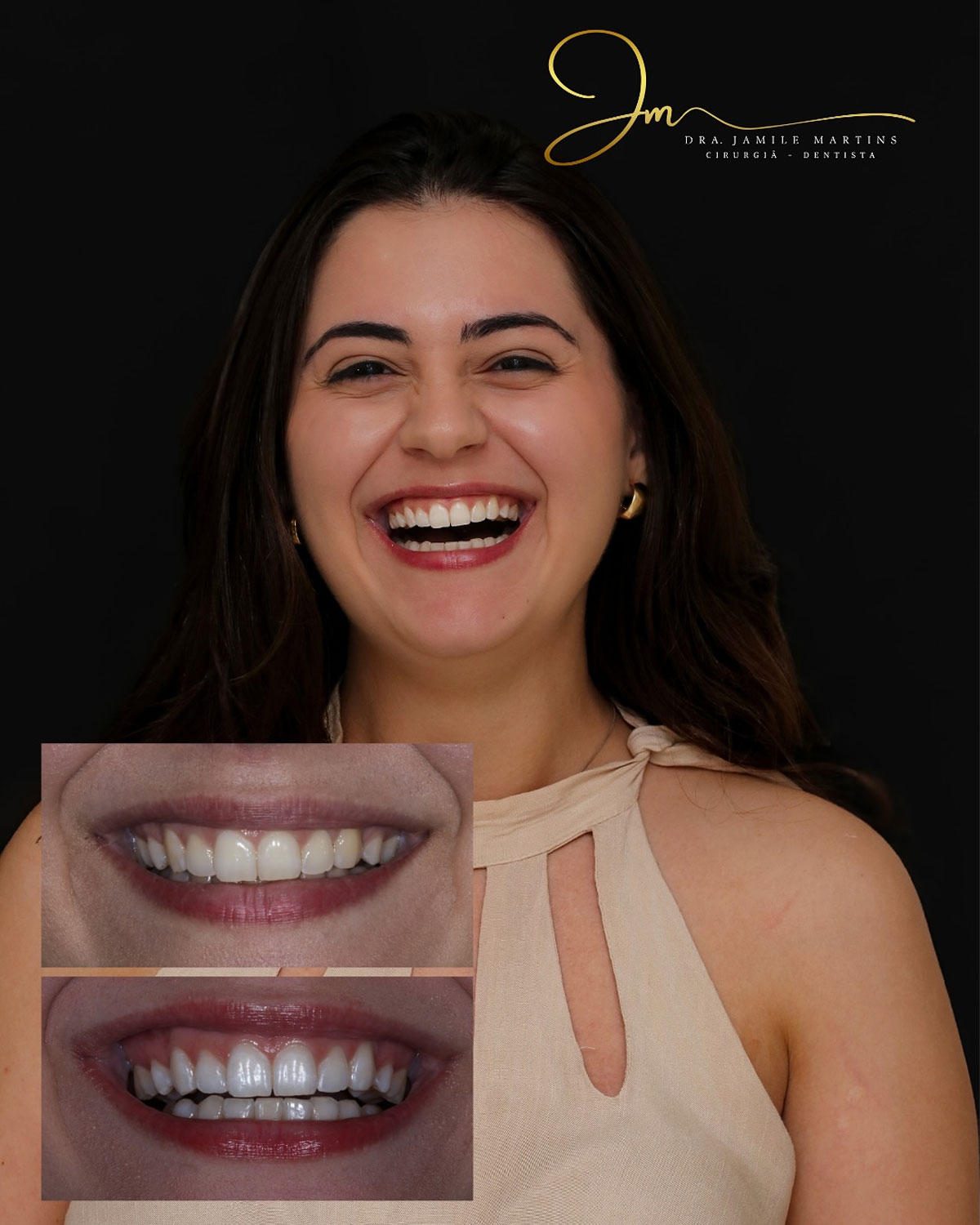 Antes e depois de clareamento dental — paciente da Dra. Jamile Martins em Londrina