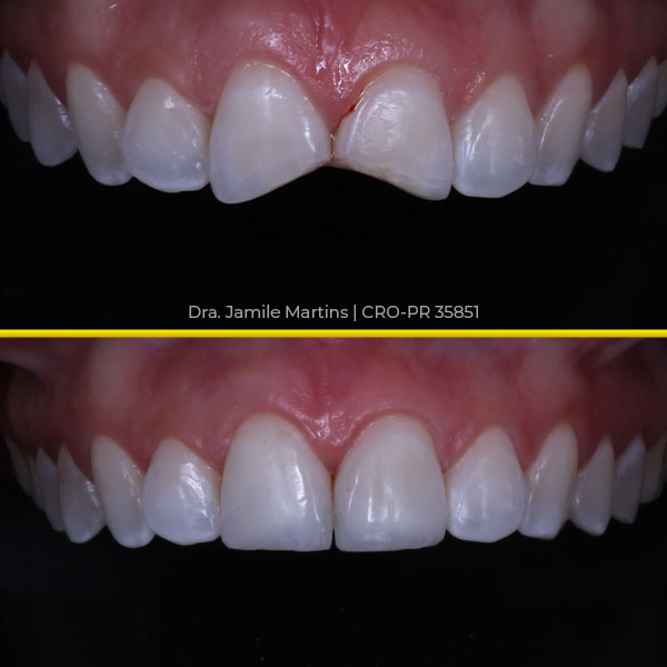 Antes e depois de faceta em resina, caso 01