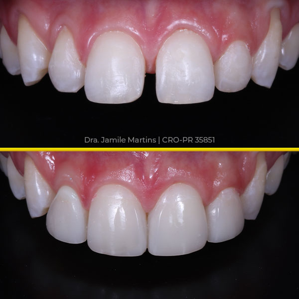 Antes e depois de faceta em resina, caso 02