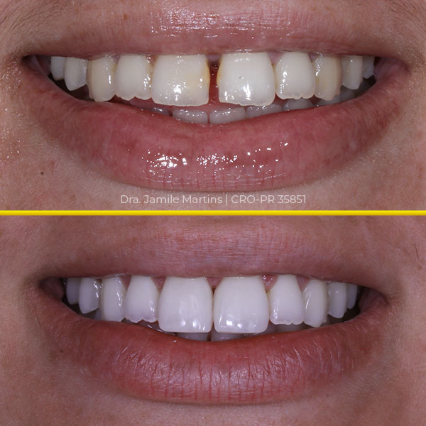 Antes e depois de faceta em resina, caso 03