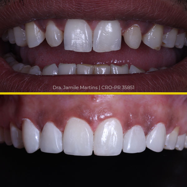 Antes e depois de faceta em resina, caso 04