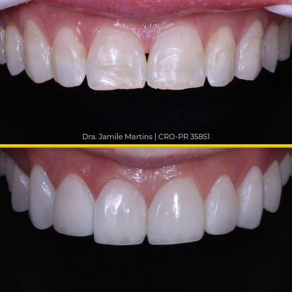 Antes e depois de faceta em resina, caso 05