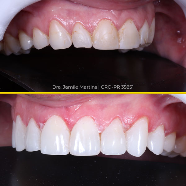 Antes e depois de faceta em resina, caso 06